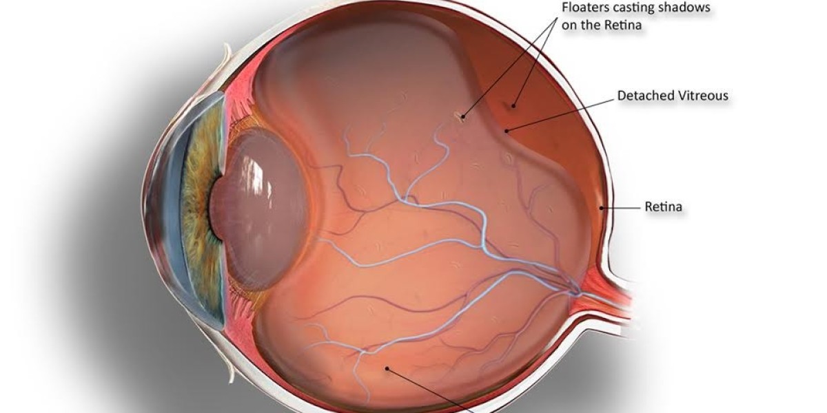 What Is Posterior Vitreous Detachment