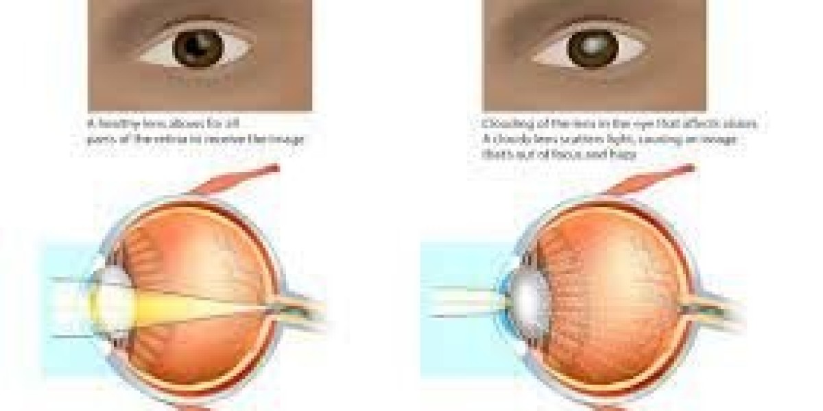 Best Cataract Eye Surgery in Bharti Eye Foundation