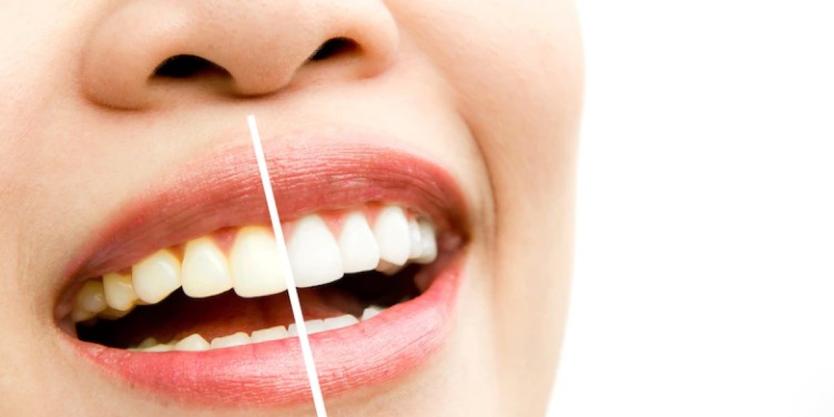 Beambar NYC: Affordable Teeth Whitening Services In The Heart of Manhattan