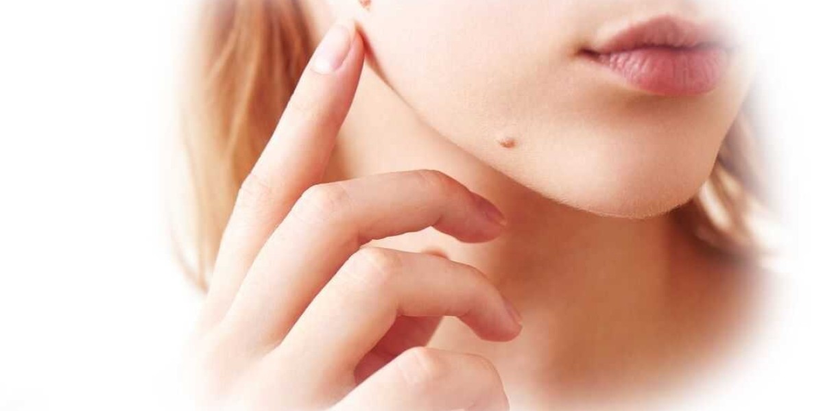 Skin Biotix Skin Tag Remover: How To Care Of Your Skin!