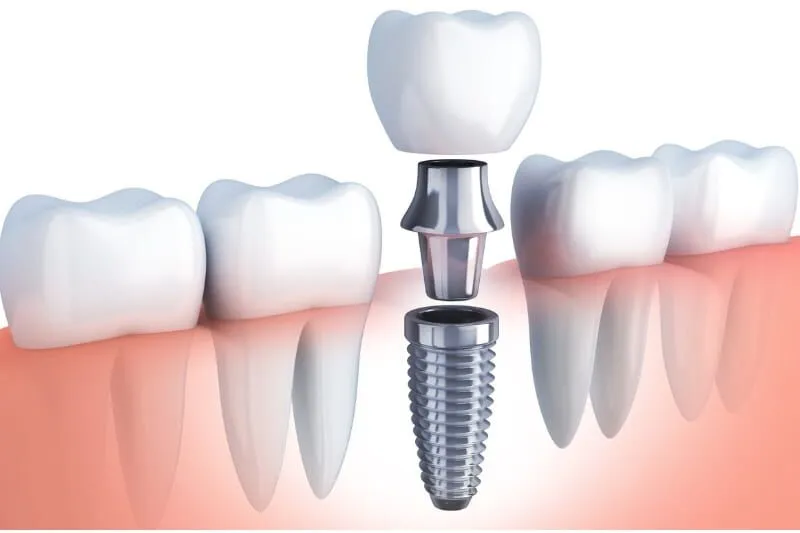 Explore The Major Purpose Of Dental Implant Treatment