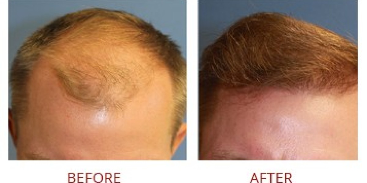 Precision Hair Restoration: Opt for FUE Excellence