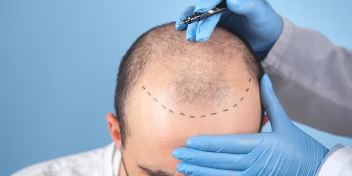 FUT Hair Transplant: What You Need to Know Before and After