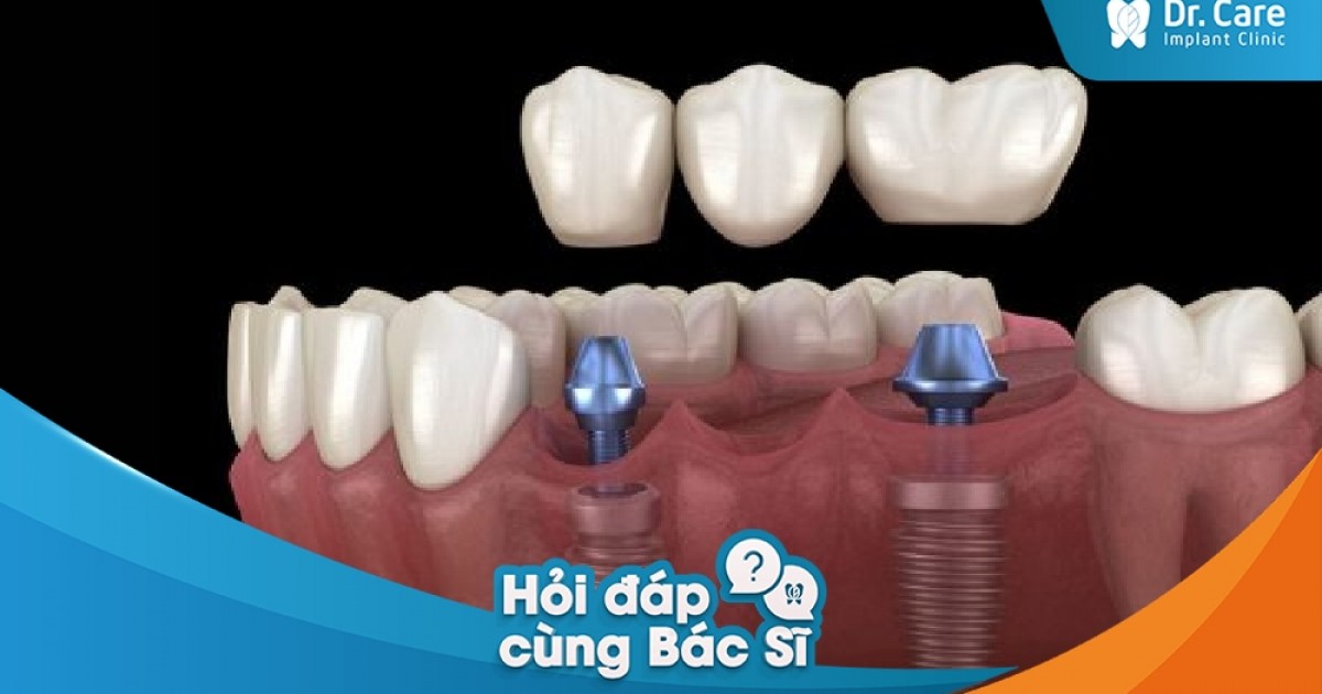 [Hỏi đáp bác sĩ] - Cách chọn răng sứ phù hợp với tài chính trước khi trồng răng sứ trên Implant | Dr. Care