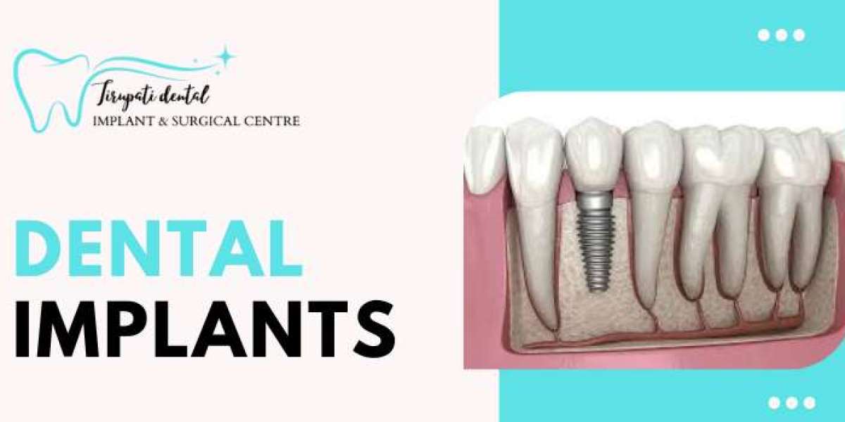 The Benefits of Dental Implants