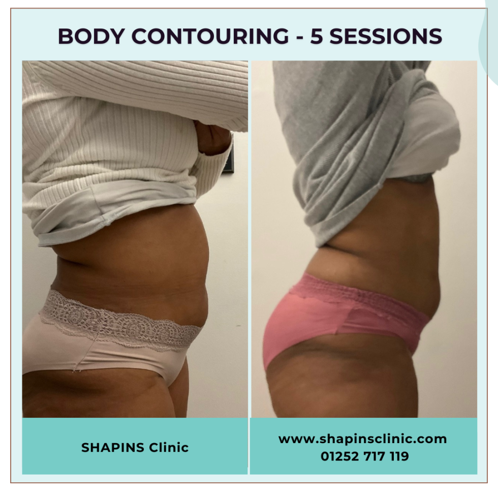 Delving into the unique body-shaping treatment realm