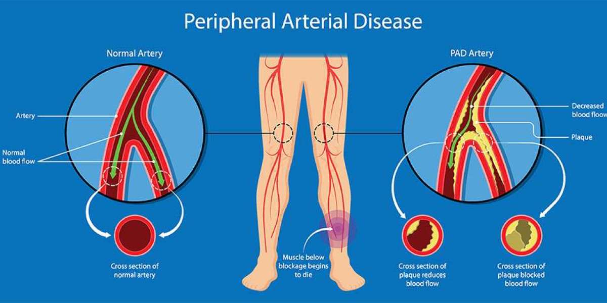 Peripheral Arterial Disease Treatment: Balancing Lifestyle Changes and Interventional Solutions