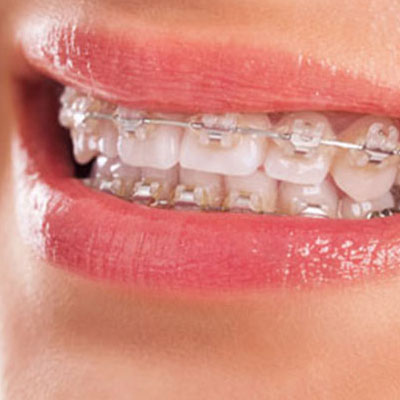 Teeth Braces | Orthodontist | Types of braces | Dr. Kalyani