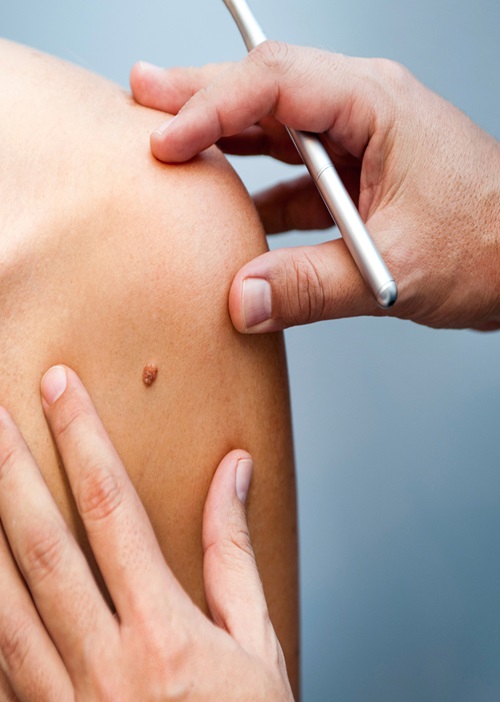 Skin Tag Removal Dandenong & Dandenong South