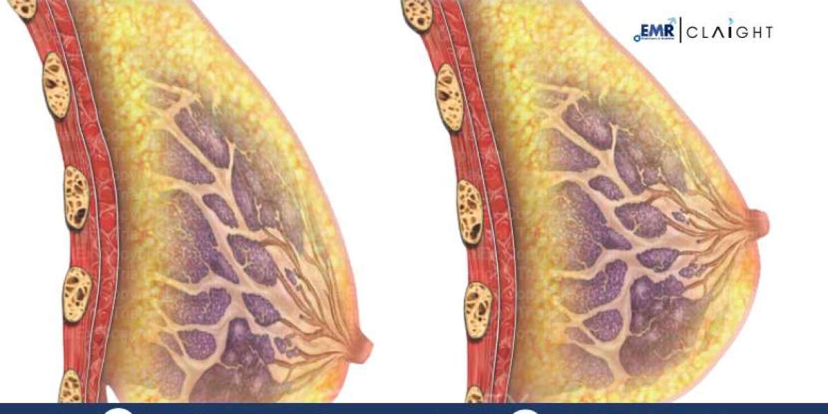 Mastopexy Market Size, Share & Forecast Analysis | 2034