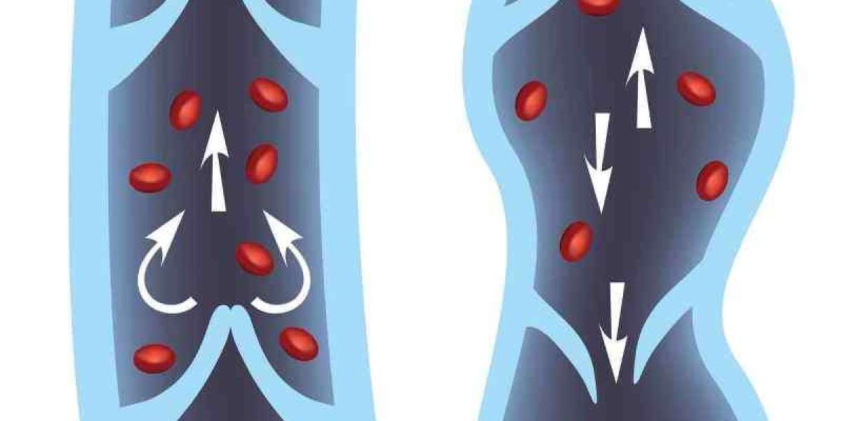 Affordable and Effective Varicose Veins Treatment in the UK – RejuvaMed Skin Clinic