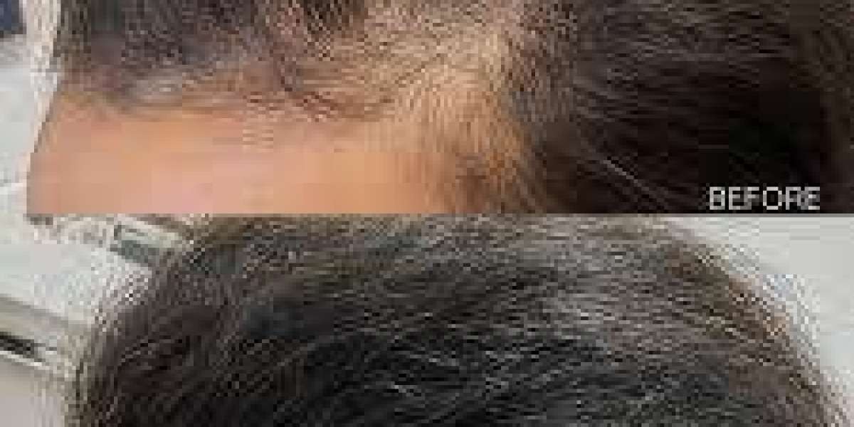 Hair Restoration Market poised for transformation through advanced automation and clinical digitization