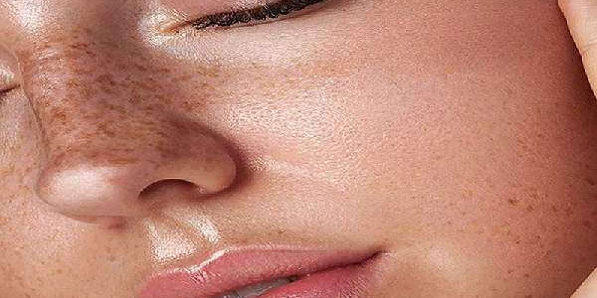 Top Dermatology Centers for Melasma Treatment in Islamabad